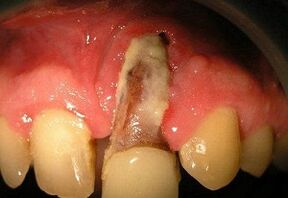 Osteomyelitis nach Zahnfeuer